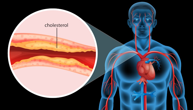 Ateriosclerosis